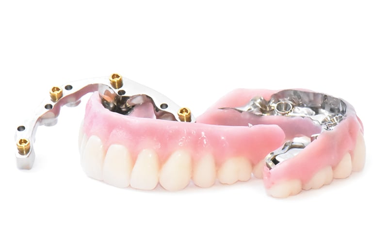 implant retained denture