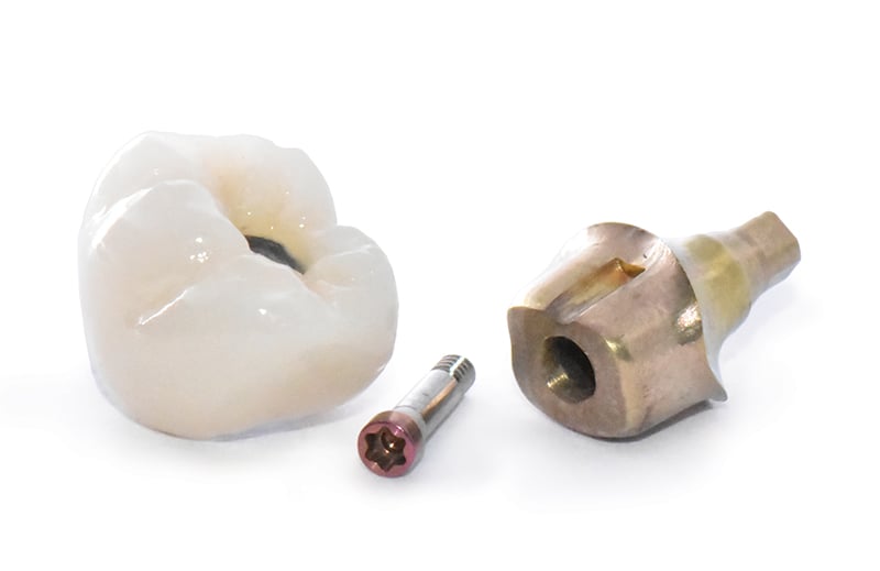 implants 2