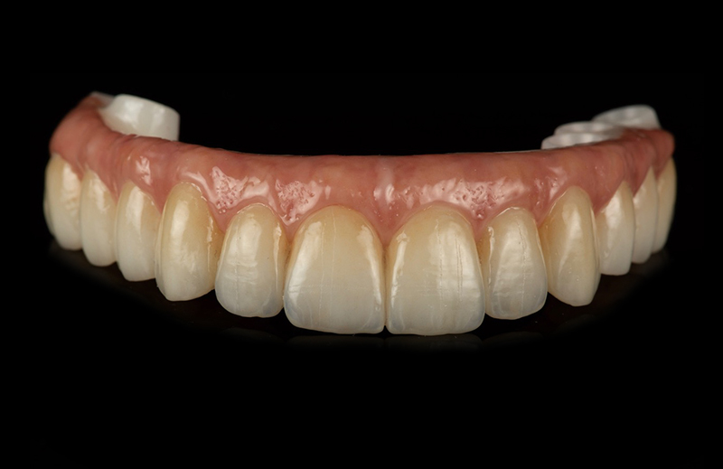 Solid Zirconia Hybrid